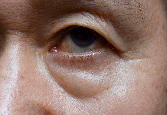 Treatments for Dark circles under eyes