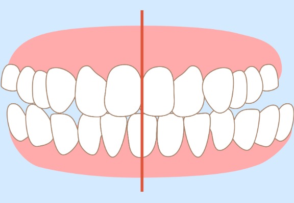How to straighten your smile