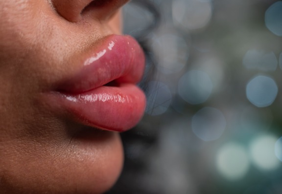 Will lips ever ‘return to normal’ after being overfilled?
