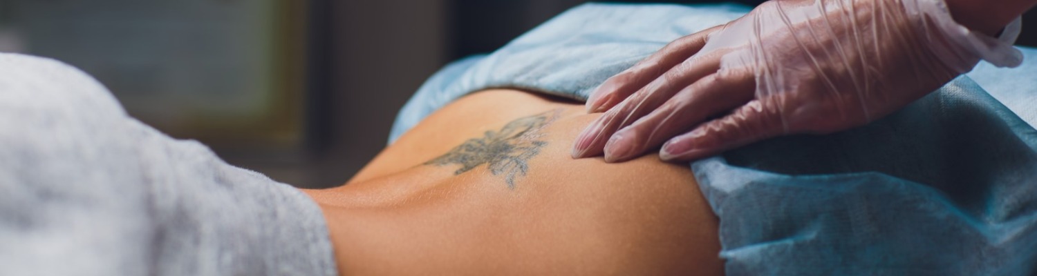 Have a Tattoo-Free Summer with Laser Tattoo Removal