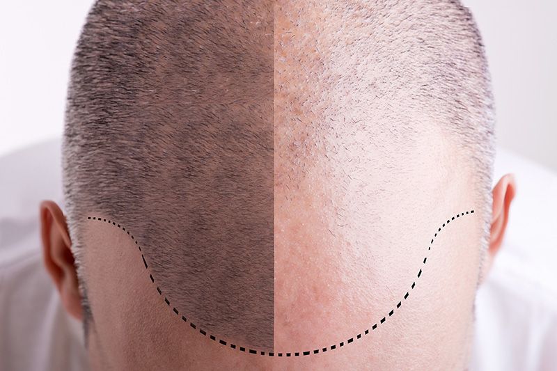 Diagnosing Male Hair Loss
