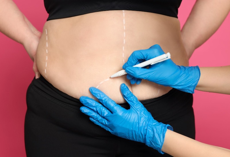 Post-Liposuction Care: What to Avoid and Dietary Suggestions