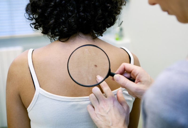 Skin Cancer: A Gentle Reminder to Be Vigilant