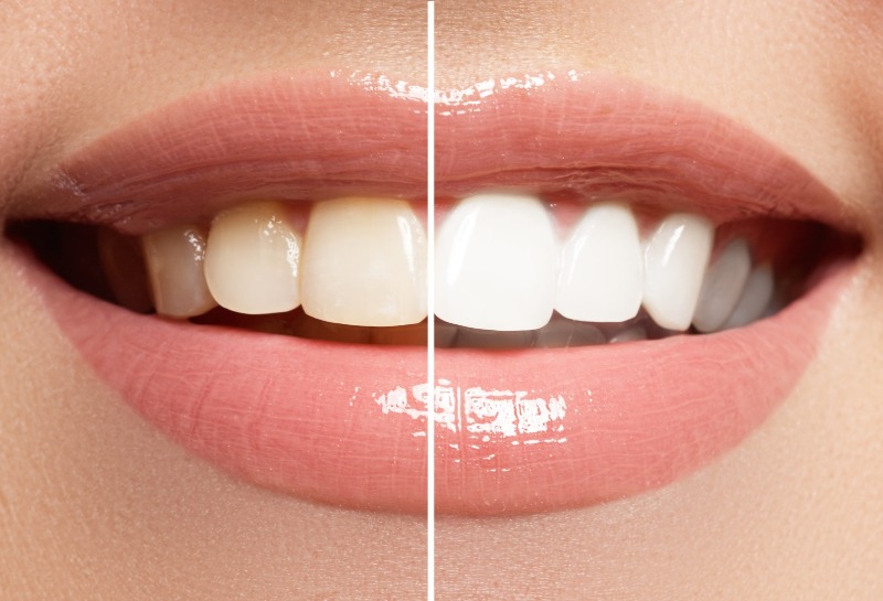Teeth Whitening - Is It Safe?