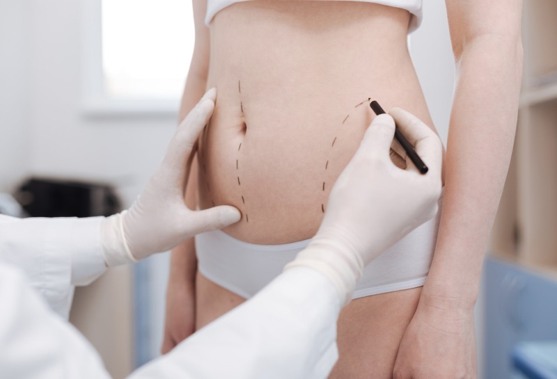 Everything You Need to Know About Tickle Lipo