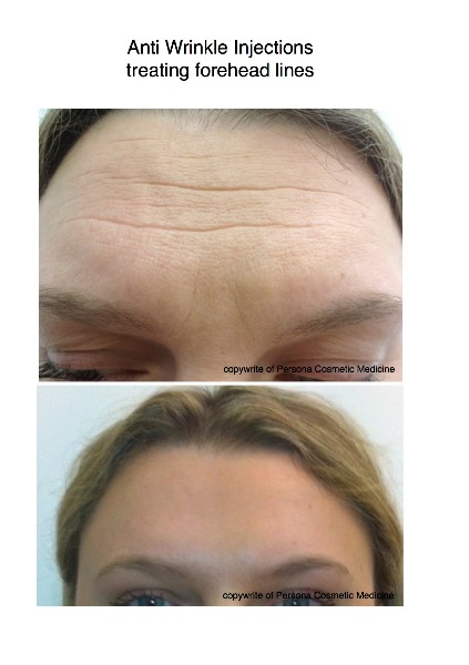 Forehead Treatment Photo