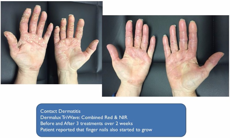 Contact Dermatitis Before and After