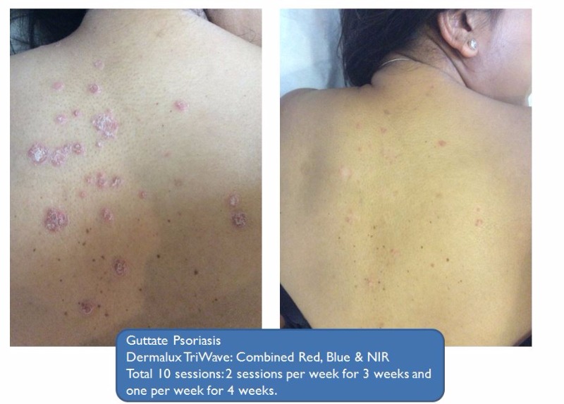 Guttate Psoriasis Before and After