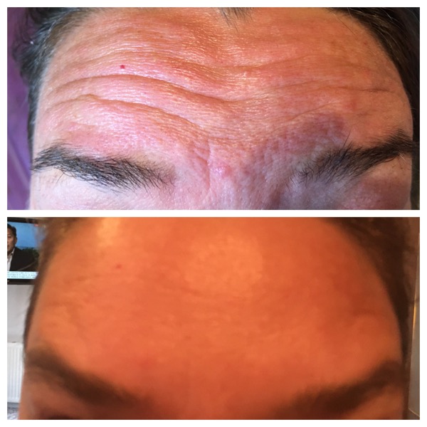Wrinkle relaxing injections to frown and forehead