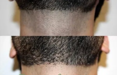 Before and after hair removal treatment