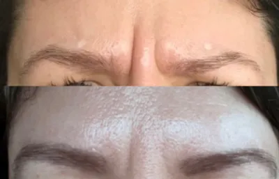 Frown line treatment 