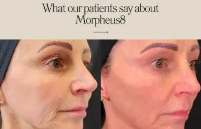 Before and after Morpheus8