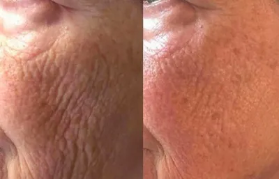 Profhilo treatment before and after