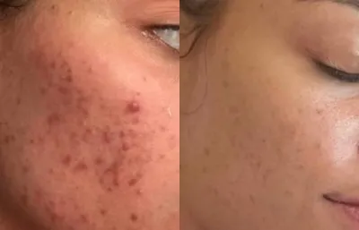 Skin rejuvenation treatment before and after