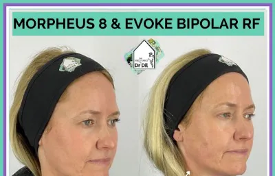 Before and after Morpheus 8 and Evoke bipolar RF