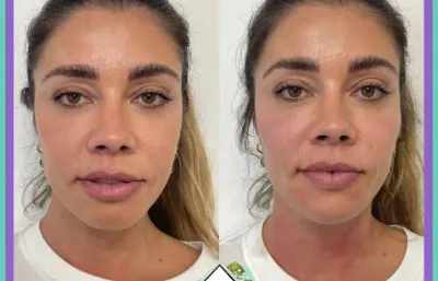Before and after skin rejuvenation treatment