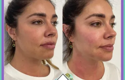 Skin rejuvenation treatment before and after