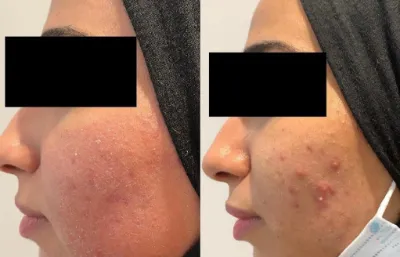 Before and after Acne treatment
