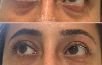 Before and after eye rejuvenation treatment