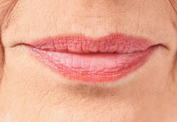 How Are Lip Lines Caused?