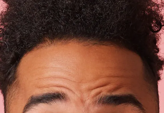 How Much Does It Cost to Treat Forehead Lines With Botox?