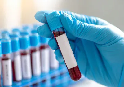 Potential Risks And Side Effects Of PRP Image