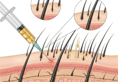 PRP for Hair Loss: Regrowth and Density Image