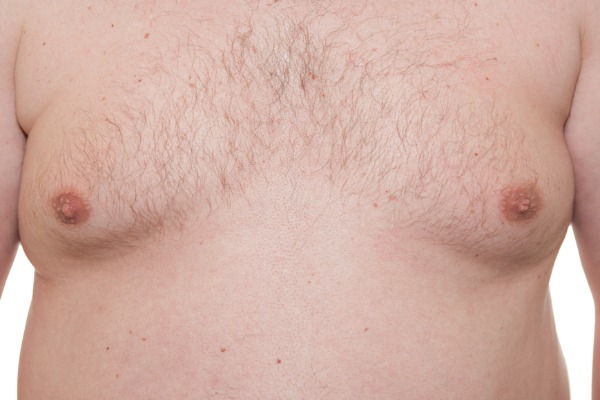 Breast Reduction (Male) Information Image