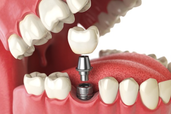 Dental Implants (Teeth) Information Image