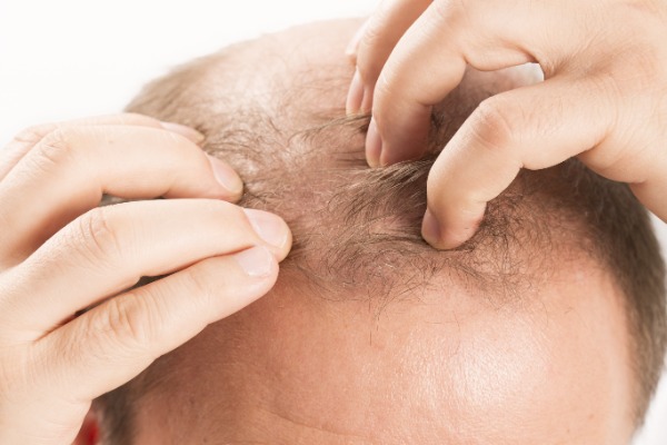Drugs to Treat Hair Loss Information Image