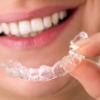 Invisible Dental Braces (Teeth)