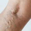 Radiofrequency Ablation (RFA) for Varicose Veins