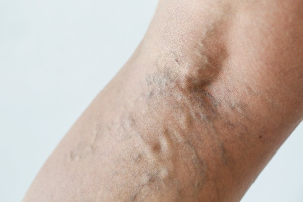 Radiofrequency Ablation (RFA) for Varicose Veins Information Image