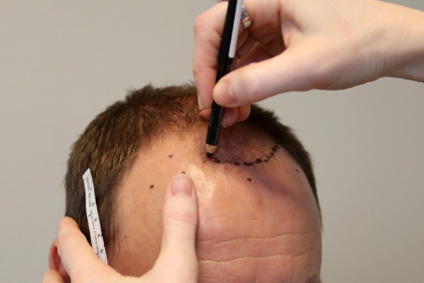 Scalp Reduction Surgery Information Image