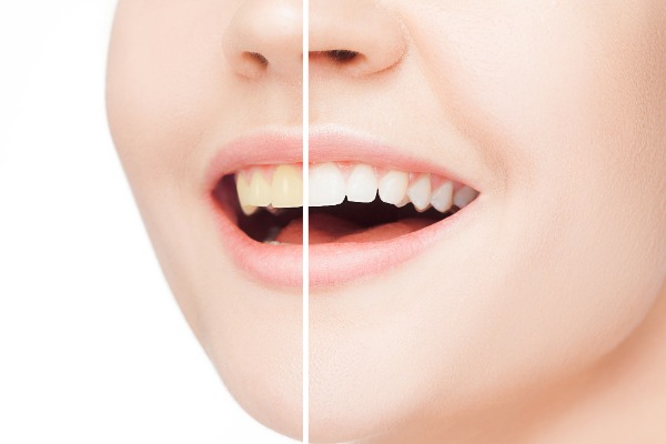 Teeth Whitening or Bleaching Information Image