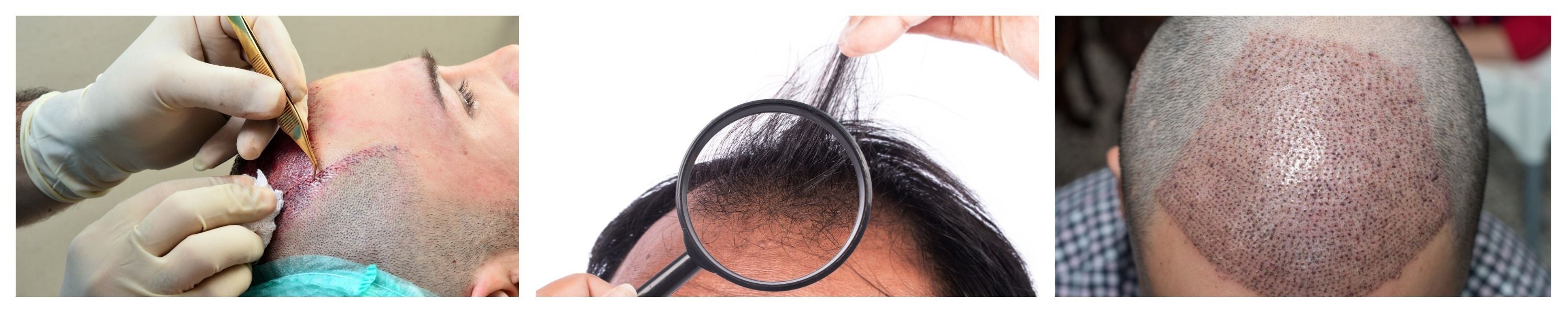 ISHRS Launches Awareness of Black Market Hair Restoration