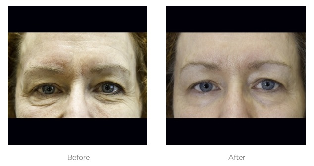 Exilis_Before_and_After_photos_Eyes