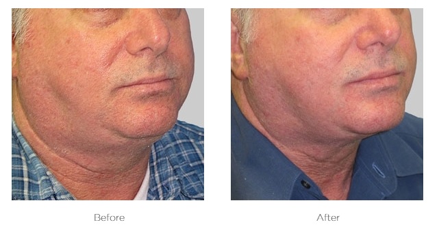 Exilis_Before_and_After_Neck
