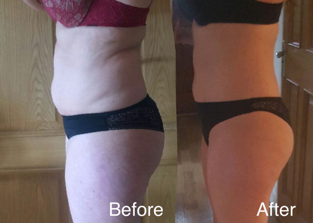 Before and After LipoContrast Female