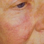 A picture of a cheek after having the veinwave treatment