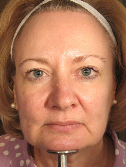 Before Treatment with Sculptra