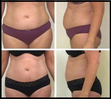 Before and After Cavitation Treatment