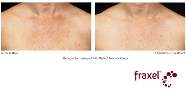 Before and After Fraxel Treatment - Chest (Decolletage)