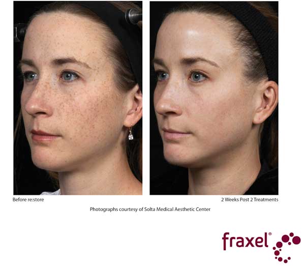 Before and After Fraxel treatment - Face