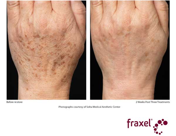 Before and After Fraxel Treatment - Hands