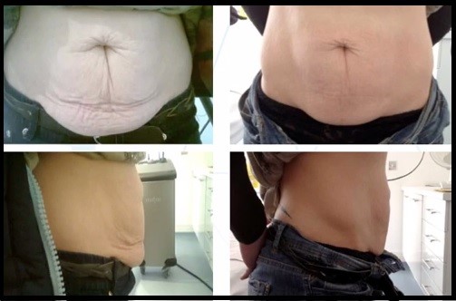 Before and After Radiofrequency Treatment