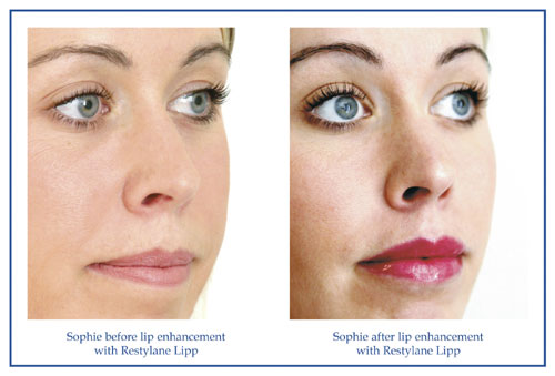 Restylane Lipp Clinical Results