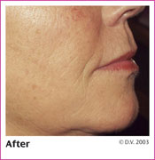 After Treatment with Sculptra