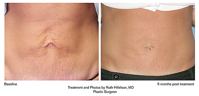 Thermage before and after for stomach tighetning
