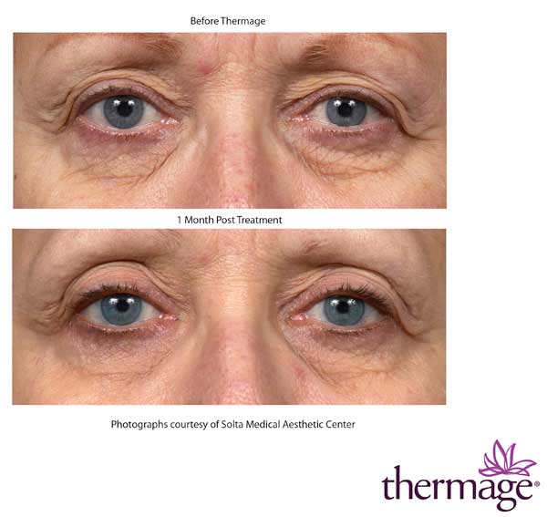 Before and After Thermage Eyes Treatment